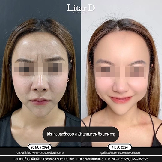 1 botox review case