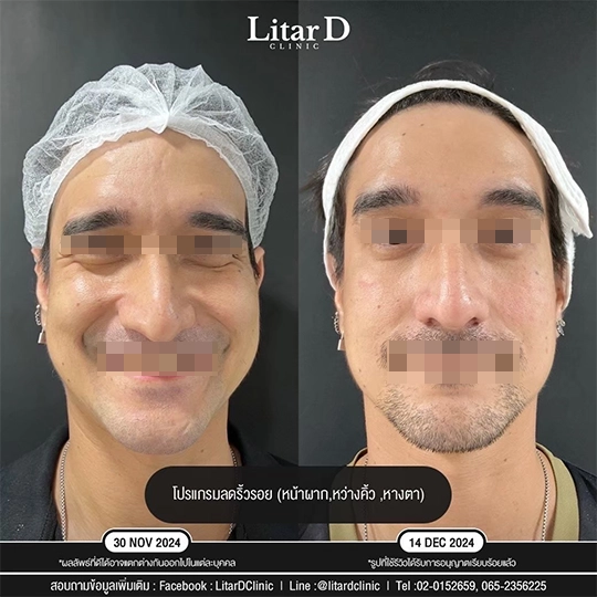 2 botox review case