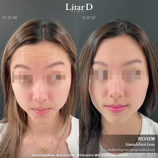 3 botox review case