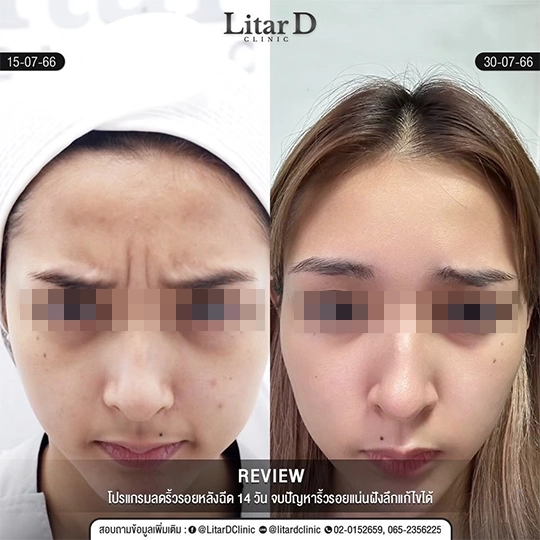 4 botox review case