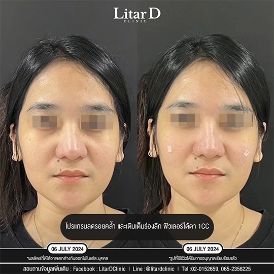 ฟิลเลอร์ใต้ตา 2