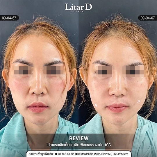 ร่องแก้ม 1