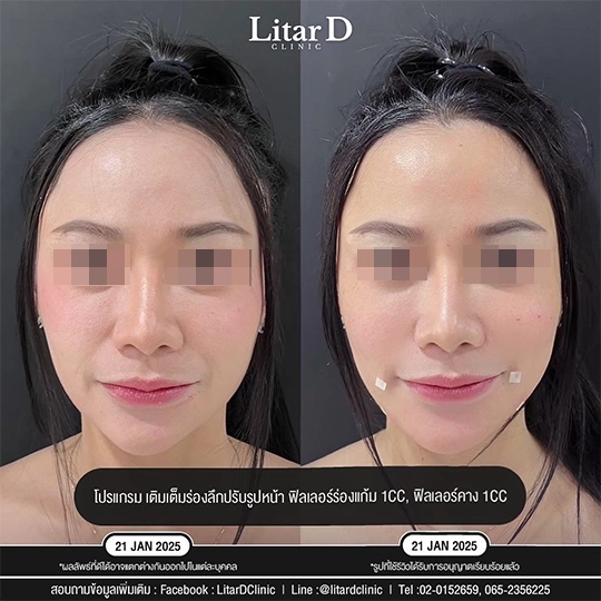 ร่องแก้ม 2