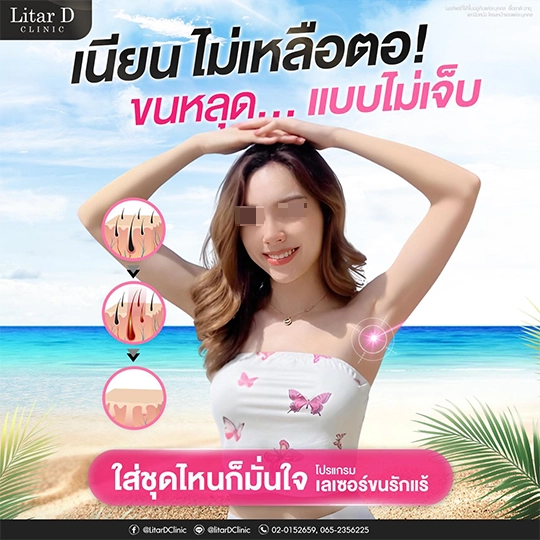 เลเซอร์ขน 2