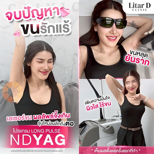 เลเซอร์ขน 3