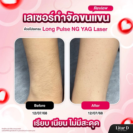 เลเซอร์ขน 9